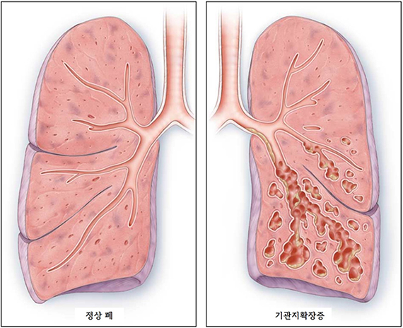 기관지확장증 관련이미지